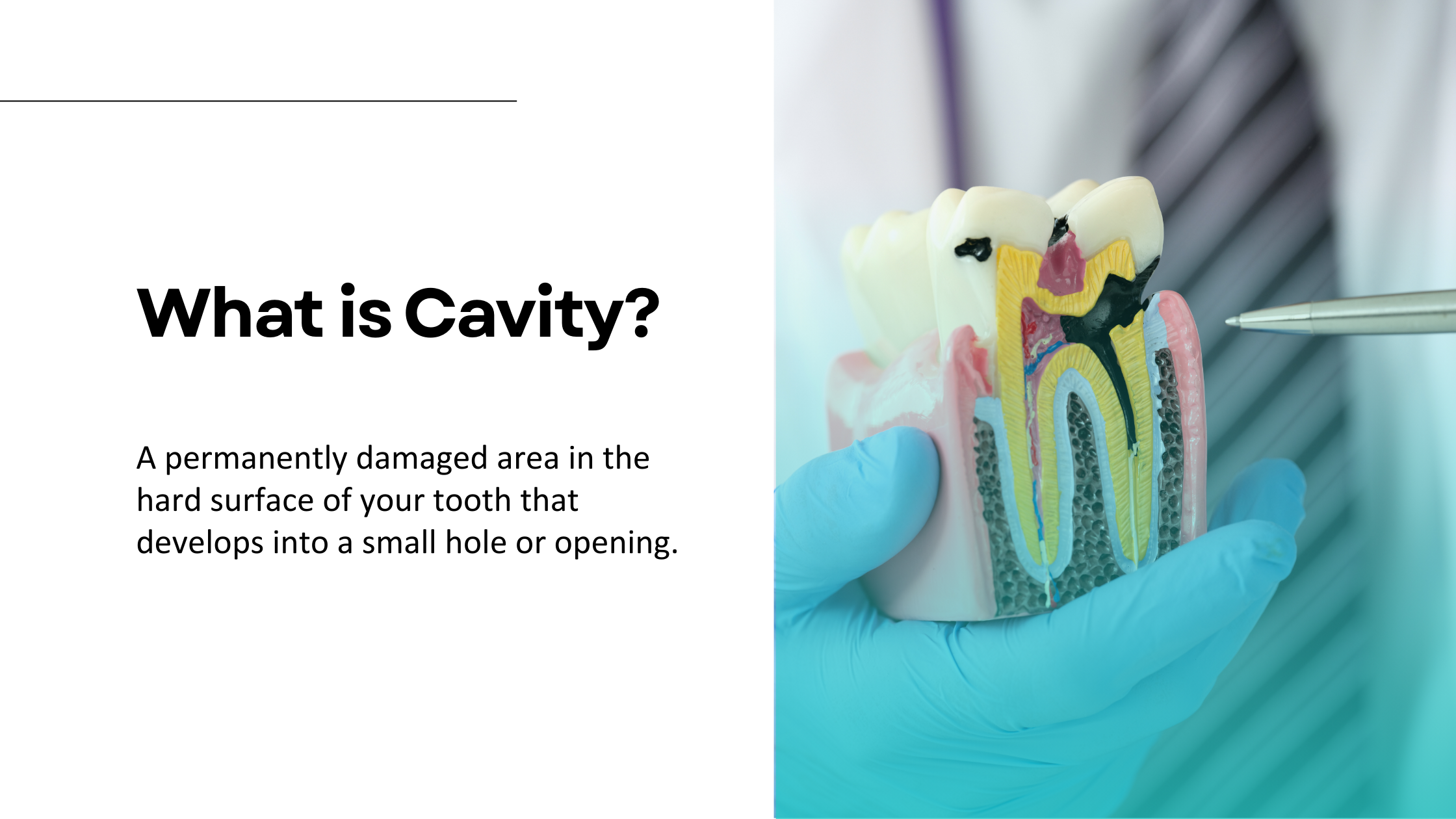 What Is A Cavity? Park City IL Dental Clinic