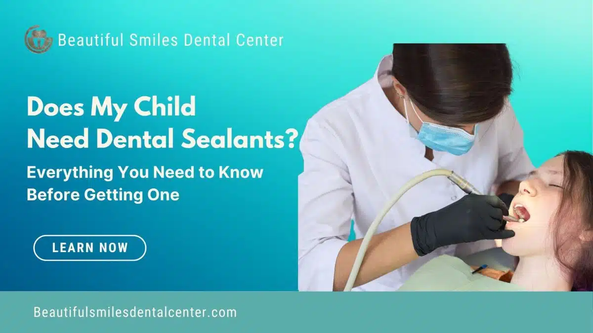 Does-My-Child-Need-Dental-Sealants-1200x675.jpg
