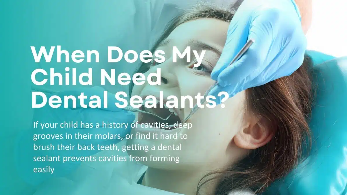 Does My Child Need Dental Sealants? Everything You Need to Know Before Getting One